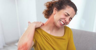 تعرف على أعراض الإصابة بالاكزيما فى المراحل العمرية المختلفة